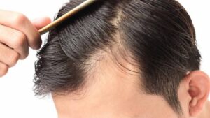 تساقط الشعر وأسبابه