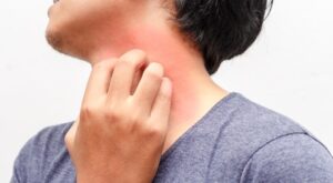 الحكة والاحمرار