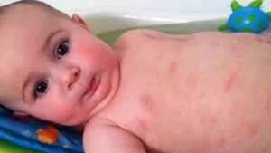 الطفح الجلدي لدى حديثي الولادة
