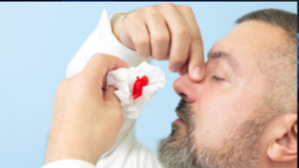 نزيف الأنف في الصيف… عرض شائع لا يُستهان به