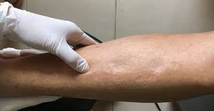 كيف أتخلص من الماء الزائد في الجسم؟