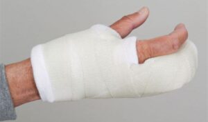 المسح على الجبيرة.. منهج الرحمة بالمصابين في فقه الطهارة