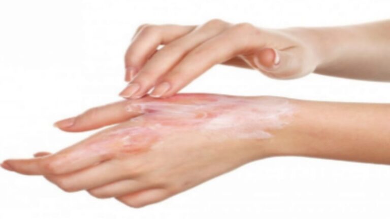 "جلد في حقنة": ابتكار ثوري لإعادة بناء الجلد وعلاج الحروق