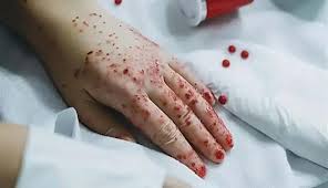 اكتشاف علمي جديد يعزز العلاجات المناعية لسرطان الدم