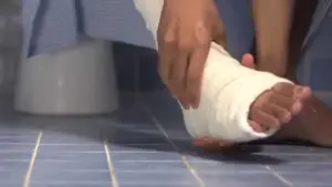 رأي الإمام أحمد بن حنبل في المسح على الجبيرة وضوابطه الفقهية